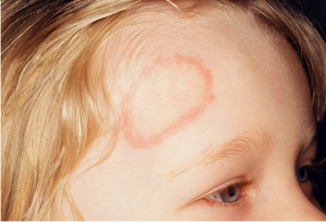 Ringworm! What is it, and How do We Get Rid of it?